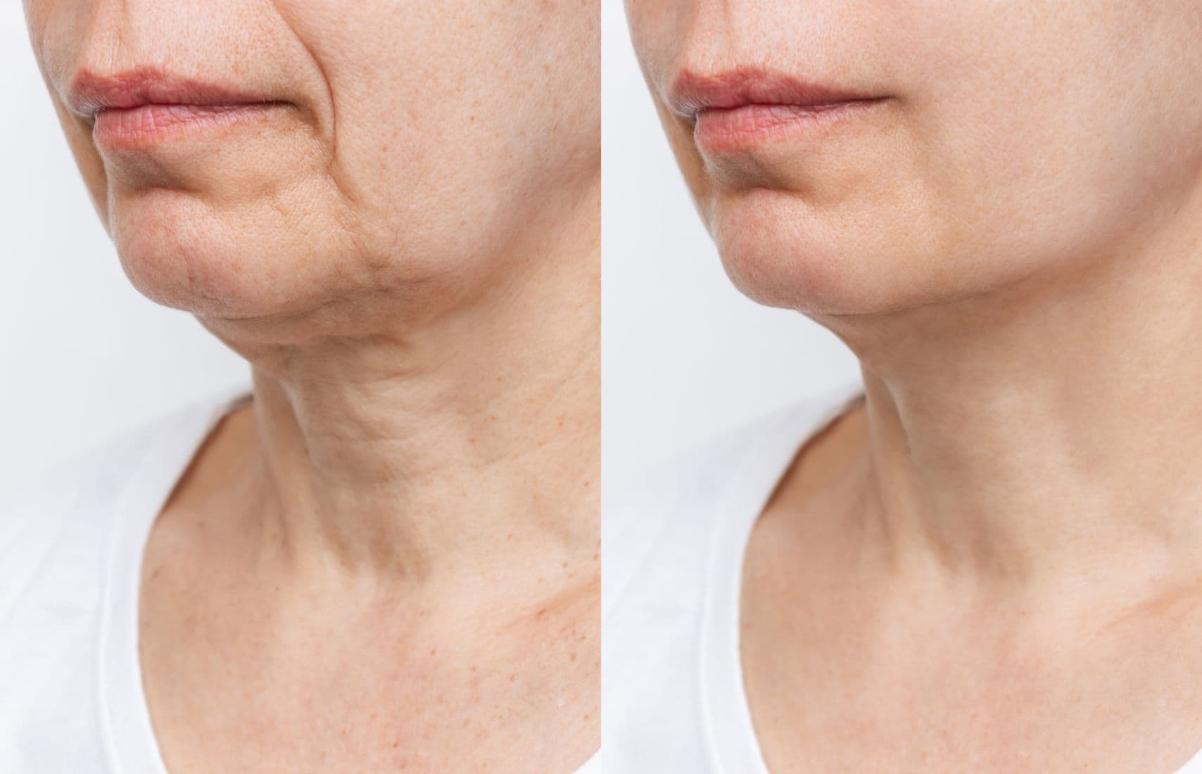 Before and after Nord Yoga.