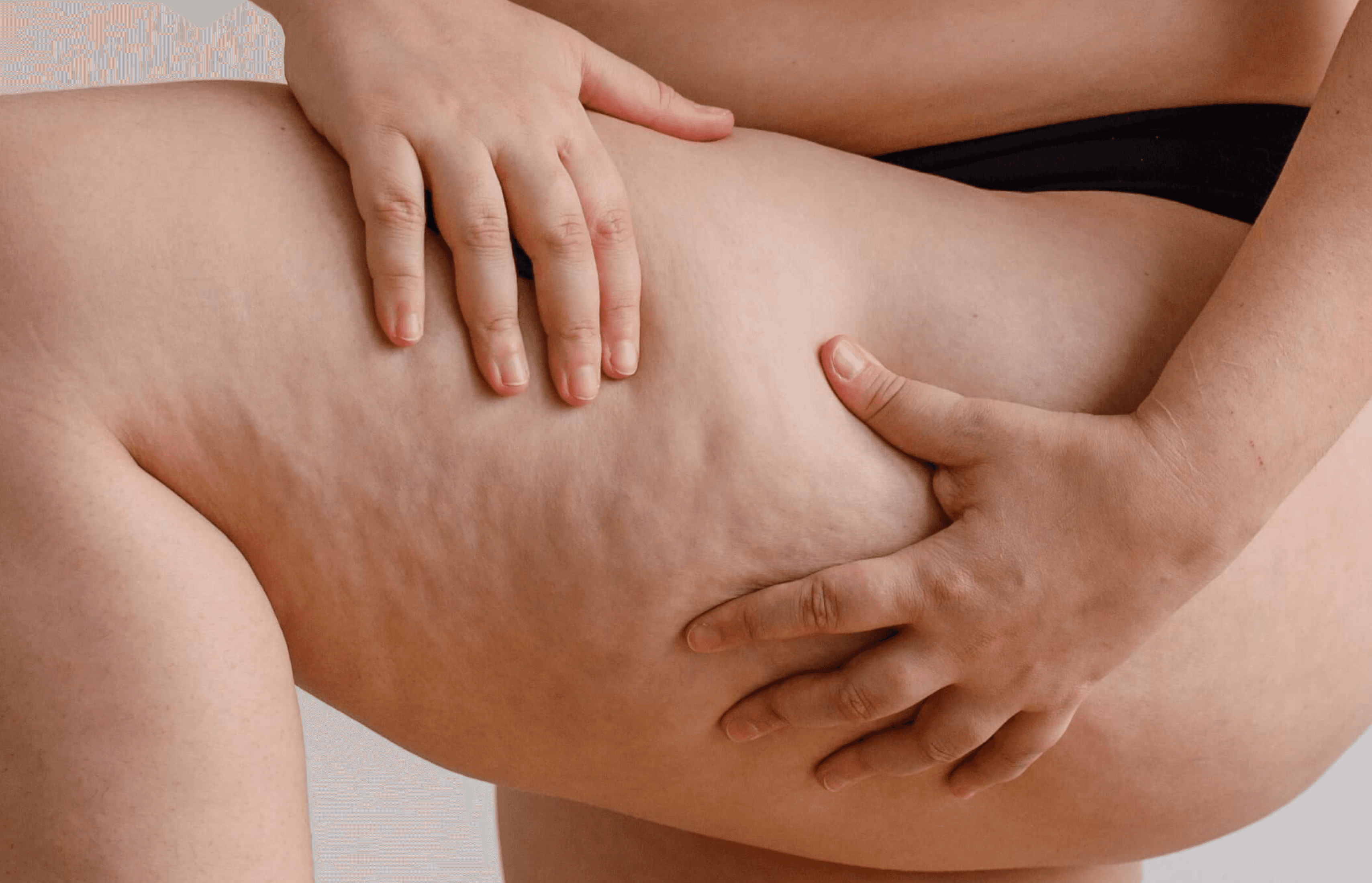 Cellulite.